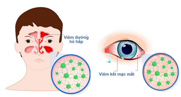 Adenovirus gây viêm đường hô hấp và viêm kết mạc mắt